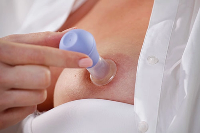 Gentle and quick nipple shaping